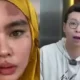 Richard Lee Tanggapi Muka Kartika Putri Alami Ruam hingga Melepuh