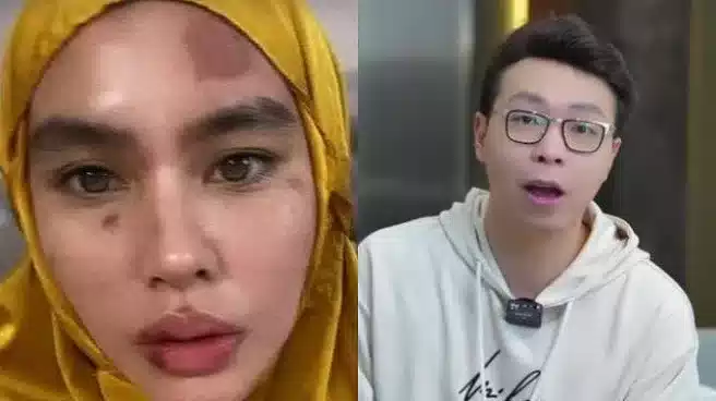 Richard Lee Tanggapi Muka Kartika Putri Alami Ruam Hingga Melepuh: Mudah-Mudahan Bukan Azab 1 Richard Lee Tanggapi Muka Kartika Putri Alami Ruam Hingga Melepuh