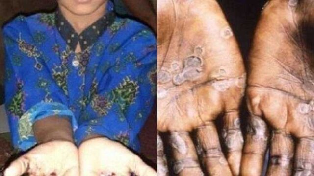 Kematian Pertama Akibat Cacar Monyet 'Mpox' di Afrika Selatan Dilaporkan 1 Kematian Pertama Akibat Cacar Monyet 'Mpox' di Afrika Selatan Dilaporkan