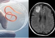 Mengerikan! Cacing Hidup 18 Cm Bersarang di Otak Pasien, Begini Cara Masuknya